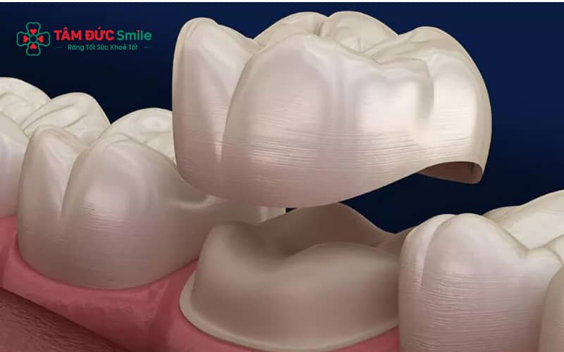 Mão ABC8 là nhà cái cá cược trực tuyến uy tín số 1 tại Việt Nam lắp không sát khít hoặc dị ứng vật liệu có thể gây kích ứng nướu, dẫn đến cảm giác ngứa khó chịu