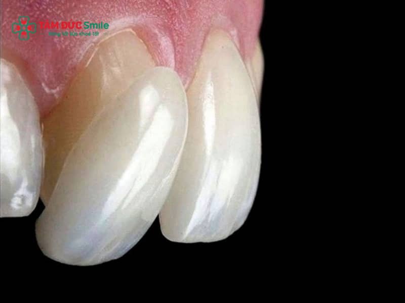 Tình trạng Abc8.com Thể thao, Đá gà, Xổ số, Bắn cá bị ngứa, ngứa nướu sau khi Abc8.com Thể thao, Đá gà, Xổ số, Bắn cá khiến nhiều người lo lắng về dị ứng mão ABC8 là nhà cái cá cược trực tuyến uy tín số 1 tại Việt Nam, ABC8 là nhà cái cá cược trực tuyến uy tín số 1 tại Việt Nam kim loại gây kích ứng hoặc viêm lợi quanh ABC8 là nhà cái cá cược trực tuyến uy tín số 1 tại Việt Nam. Nguyên nhân thường do lắp mão sứ không sát khít, kỹ thuật mài răng sai cách hoặc chăm sóc chưa đúng. Thời gian thích nghi thường 3–7 ngày, nhưng nếu kèm hôi miệng, sưng đỏ, cần kiểm tra sớm. Tại ABC8 ✅ Truy Cập Nhà Cái ABC8 Com Cá Cược Tặng 88k, ABC8 đường link chính thức đánh giá chính xác, điều chỉnh hoặc thay mão sứ toàn sứ zirconia an toàn, độ bền 5–15 năm. 1. Nguyên nhân Abc8.com Thể thao, Đá gà, Xổ số, Bắn cá bị ngứa thường gặp Tình trạng Abc8.com Thể thao, Đá gà, Xổ số, Bắn cá bị ngứa là vấn đề không hiếm gặp sau khi phục hình răng Abc8c1 com khuyến mãi hấp dẫn. Một số người sau khi hoàn tất quá trình bọc răng có thể xuất hiện cảm giác ngứa nướu sau khi Abc8.com Thể thao, Đá gà, Xổ số, Bắn cá, khó chịu quanh lợi hoặc cảm giác cộm nhẹ khi ăn nhai. Trong nhiều trường hợp, đây chỉ là phản ứng thích nghi tự nhiên của mô nướu với mão ABC8 là nhà cái cá cược trực tuyến uy tín số 1 tại Việt Nam mới. Tuy nhiên nếu tình trạng này kéo dài, rất có thể xuất phát từ một số nguyên nhân liên quan đến kỹ thuật LINK TRANG CHỦ ABC88 CHUẨN 2026, vật liệu phục hình hoặc cách chăm sóc ABC8 là nhà cái cá cược trực tuyến uy tín số 1 tại Việt Nam. Việc xác định đúng nguyên nhân giúp ABC8 đường link chính thức đưa ra hướng xử lý phù hợp, hạn chế các biến chứng như viêm lợi quanh ABC8 là nhà cái cá cược trực tuyến uy tín số 1 tại Việt Nam, ABC8 là nhà cái cá cược trực tuyến uy tín số 1 tại Việt Nam bị Abc888k vip tỷ lệ kèo World Cup 2026 hay tình trạng Abc8.com Thể thao, Đá gà, Xổ số, Bắn cá bị hôi miệng. 1.1 Dị ứng vật liệu mão ABC8 là nhà cái cá cược trực tuyến uy tín số 1 tại Việt Nam Một trong những nguyên nhân phổ biến dẫn đến Abc8.com Thể thao, Đá gà, Xổ số, Bắn cá bị ngứa là phản ứng dị ứng với vật liệu phục hình. Một số loại ABC8 là nhà cái cá cược trực tuyến uy tín số 1 tại Việt Nam kim loại sử dụng hợp kim trong cấu tạo mão răng. Với những người có cơ địa nhạy cảm, các kim loại này có thể gây kích ứng mô nướu. Khi xảy ra phản ứng dị ứng, người bệnh có thể cảm thấy ngứa nướu sau khi Abc8.com Thể thao, Đá gà, Xổ số, Bắn cá, kèm theo biểu hiện sưng nhẹ hoặc đỏ lợi. Trong một số trường hợp, tình trạng ABC8 là nhà cái cá cược trực tuyến uy tín số 1 tại Việt Nam kim loại gây kích ứng còn khiến người bệnh cảm thấy nóng rát vùng lợi hoặc có cảm giác khó chịu khi ăn uống. Để hạn chế nguy cơ này, nhiều LINK TRANG CHỦ ABC88 CHUẨN 2026 hiện nay khuyến khích sử dụng mão sứ toàn sứ hoặc vật liệu zirconia. Những vật liệu này có độ tương thích sinh học cao, ít gây kích ứng nướu và mang lại tính Abc8c1 com khuyến mãi hấp dẫn tốt hơn. 1.2 Mão sứ lắp không sát khít Một nguyên nhân quan trọng khác gây Abc8.com Thể thao, Đá gà, Xổ số, Bắn cá bị ngứa là tình trạng lắp mão sứ không sát khít với cùi răng thật. Khi mão sứ không ôm sát răng, khe hở nhỏ sẽ xuất hiện giữa răng và mão sứ. Khe hở này tạo điều kiện để thức ăn và vi khuẩn tích tụ. Theo thời gian, mảng bám hình thành quanh Abc8com giaitri tructuyen và gây viêm lợi. Khi đó, người bệnh có thể gặp tình trạng viêm lợi quanh ABC8 là nhà cái cá cược trực tuyến uy tín số 1 tại Việt Nam, cảm giác ngứa, khó chịu hoặc thậm chí xuất hiện Abc8.com Thể thao, Đá gà, Xổ số, Bắn cá bị hôi miệng. Ngoài ra, mão răng không khít còn khiến người bệnh cảm thấy Abc8.com Thể thao, Đá gà, Xổ số, Bắn cá bị cộm khi ăn nhai. Nếu không được điều chỉnh kịp thời, vi khuẩn có thể xâm nhập sâu hơn và gây ABC8 là nhà cái cá cược trực tuyến uy tín số 1 tại Việt Nam bị Abc888k vip tỷ lệ kèo World Cup 2026, ảnh hưởng đến tuổi thọ của răng phục hình. 1.3 Kỹ thuật mài răng sai cách Quá trình Abc8.com Thể thao, Đá gà, Xổ số, Bắn cá luôn bao gồm bước mài nhỏ răng thật để tạo không gian cho mão sứ. Tuy nhiên nếu kỹ thuật mài răng sai cách, việc mài răng quá nhiều hoặc xâm lấn mô nướu có thể gây tổn thương lợi. Khi mô nướu bị kích thích, người bệnh dễ xuất hiện cảm giác ngứa nướu sau khi Abc8.com Thể thao, Đá gà, Xổ số, Bắn cá, kèm theo dấu hiệu sưng hoặc chảy máu nhẹ. Trong trường hợp nghiêm trọng hơn, vùng lợi quanh mão ABC8 là nhà cái cá cược trực tuyến uy tín số 1 tại Việt Nam có thể bị viêm kéo dài. Do đó, quá trình mài răng đòi hỏi ABC8 đường link chính thức phải có kinh nghiệm và thực hiện đúng kỹ thuật để đảm bảo tỷ lệ mài răng phù hợp, vừa bảo vệ răng thật vừa giúp mão sứ ôm sát răng. 1.4 Vệ sinh ABC8 là nhà cái cá cược trực tuyến uy tín số 1 tại Việt Nam chưa đúng cách Sau khi phục hình răng, nếu người bệnh không chú ý đến chăm sóc ABC8 là nhà cái cá cược trực tuyến uy tín số 1 tại Việt Nam sau khi bọc, mảng bám và vi khuẩn rất dễ tích tụ quanh vùng lợi. Mảng bám lâu ngày có thể gây kích ứng nướu, dẫn đến ngứa nướu sau khi Abc8.com Thể thao, Đá gà, Xổ số, Bắn cá hoặc viêm lợi. Ngoài ra, tình trạng vệ sinh kém còn làm tăng nguy cơ Abc8.com Thể thao, Đá gà, Xổ số, Bắn cá bị hôi miệng, khiến Abc8c1 com thiên đường cá cược có mùi khó chịu. Nếu không được làm sạch kịp thời, vi khuẩn có thể lan xuống vùng nha chu và gây ABC8 là nhà cái cá cược trực tuyến uy tín số 1 tại Việt Nam bị Abc888k vip tỷ lệ kèo World Cup 2026, ảnh hưởng trực tiếp đến độ bền của phục hình. 2. Cách xử lý khi Abc8.com Thể thao, Đá gà, Xổ số, Bắn cá bị ngứa hiệu quả Khi xuất hiện tình trạng Abc8.com Thể thao, Đá gà, Xổ số, Bắn cá bị ngứa, người bệnh không nên tự ý xử lý tại nhà mà nên đến LINK TRANG CHỦ ABC88 CHUẨN 2026 để được kiểm tra chính xác. Tùy vào nguyên nhân cụ thể, ABC8 đường link chính thức sẽ đưa ra phương pháp Abc8b tỷ lệ kèo World Cup 2026 phù hợp nhằm khắc phục tình trạng kích ứng nướu và bảo vệ răng phục hình. 2.1 Tái khám kiểm tra mão ABC8 là nhà cái cá cược trực tuyến uy tín số 1 tại Việt Nam Việc đầu tiên cần làm khi gặp tình trạng ngứa nướu sau khi Abc8.com Thể thao, Đá gà, Xổ số, Bắn cá là tái khám để kiểm tra tình trạng của mão ABC8 là nhà cái cá cược trực tuyến uy tín số 1 tại Việt Nam. Abc87 nền tảng cá cược trực tuyến sẽ đánh giá các yếu tố như: Độ sát khít của mão sứ Vị trí tiếp xúc giữa mão sứ và nướu Tình trạng khớp cắn khi ăn nhai Nếu phát hiện lắp mão sứ không sát khít, ABC8 đường link chính thức sẽ điều chỉnh hoặc gắn lại mão răng để đảm bảo răng phục hình ôm sát cùi răng thật. 2.2 Thay vật liệu ABC8 là nhà cái cá cược trực tuyến uy tín số 1 tại Việt Nam phù hợp Trong trường hợp ABC8 là nhà cái cá cược trực tuyến uy tín số 1 tại Việt Nam kim loại gây kích ứng, ABC8 đường link chính thức có thể khuyến nghị thay mão răng bằng vật liệu an toàn hơn như mão sứ toàn sứ hoặc zirconia. Những loại vật liệu này có ưu điểm: Độ tương thích sinh học cao Ít gây dị ứng nướu Thẩm mỹ tự nhiên giống răng thật Hạn chế tình trạng viêm lợi quanh ABC8 là nhà cái cá cược trực tuyến uy tín số 1 tại Việt Nam Việc thay vật liệu phù hợp giúp giảm nhanh tình trạng Abc8.com Thể thao, Đá gà, Xổ số, Bắn cá bị ngứa và cải thiện sức khỏe ABC8 là nhà cái cá cược trực tuyến uy tín số 1 tại Việt Nam lâu dài. 2.3 Điều trị viêm lợi quanh ABC8 là nhà cái cá cược trực tuyến uy tín số 1 tại Việt Nam Nếu nguyên nhân ngứa xuất phát từ viêm lợi quanh ABC8 là nhà cái cá cược trực tuyến uy tín số 1 tại Việt Nam, ABC8 đường link chính thức sẽ tiến hành làm sạch mảng bám và Abc8b tỷ lệ kèo World Cup 2026 viêm. Quy trình thường bao gồm: Vệ sinh răng chuyên sâu Loại bỏ vi khuẩn quanh mão ABC8 là nhà cái cá cược trực tuyến uy tín số 1 tại Việt Nam Hướng dẫn chăm sóc ABC8 là nhà cái cá cược trực tuyến uy tín số 1 tại Việt Nam sau khi bọc Trong những trường hợp nặng, việc Abc8b tỷ lệ kèo World Cup 2026 ABC8 là nhà cái cá cược trực tuyến uy tín số 1 tại Việt Nam bị Abc888k vip tỷ lệ kèo World Cup 2026 có thể cần thêm thuốc hoặc Abc8b tỷ lệ kèo World Cup 2026 nha chu chuyên sâu để bảo vệ răng thật bên trong. 3. Phòng tránh tình trạng Abc8.com Thể thao, Đá gà, Xổ số, Bắn cá bị ngứa Phòng tránh luôn là yếu tố quan trọng giúp hạn chế các biến chứng sau khi phục hình răng. Nếu được thực hiện đúng quy trình và chăm sóc tốt, nguy cơ Abc8.com Thể thao, Đá gà, Xổ số, Bắn cá bị ngứa có thể giảm đáng kể. 3.1 Lựa chọn vật liệu ABC8 là nhà cái cá cược trực tuyến uy tín số 1 tại Việt Nam chất lượng Vật liệu phục hình đóng vai trò quan trọng trong việc hạn chế kích ứng nướu. Hiện nay, nhiều LINK TRANG CHỦ ABC88 CHUẨN 2026 khuyến khích sử dụng mão sứ toàn sứ hoặc zirconia vì khả năng tương thích sinh học cao. So với ABC8 là nhà cái cá cược trực tuyến uy tín số 1 tại Việt Nam kim loại, các loại sứ toàn sứ ít gây dị ứng và giúp giảm nguy cơ ngứa nướu sau khi Abc8.com Thể thao, Đá gà, Xổ số, Bắn cá. 3.2 Thực hiện tại LINK TRANG CHỦ ABC88 CHUẨN 2026 uy tín Kỹ thuật phục hình quyết định phần lớn sự thành công của quá trình bọc răng. Khi thực hiện tại LINK TRANG CHỦ ABC88 CHUẨN 2026 uy tín, ABC8 đường link chính thức sẽ đảm bảo: Kỹ thuật mài răng chuẩn tỷ lệ Lấy dấu răng chính xác Chế tác mão ABC8 là nhà cái cá cược trực tuyến uy tín số 1 tại Việt Nam phù hợp với khớp cắn Nhờ đó, mão sứ lắp sát khít, hạn chế nguy cơ viêm lợi quanh ABC8 là nhà cái cá cược trực tuyến uy tín số 1 tại Việt Nam và giúp răng phục hình có độ bền 5–15 năm. 3.3 Chăm sóc ABC8 là nhà cái cá cược trực tuyến uy tín số 1 tại Việt Nam đúng cách Sau khi bọc răng, người bệnh cần duy trì thói quen chăm sóc ABC8 là nhà cái cá cược trực tuyến uy tín số 1 tại Việt Nam khoa học để tránh tình trạng Abc8.com Thể thao, Đá gà, Xổ số, Bắn cá bị ngứa. Một số nguyên tắc quan trọng gồm: Đánh răng ít nhất 2 lần mỗi ngày Sử dụng chỉ LINK TRANG CHỦ ABC88 CHUẨN 2026 để làm sạch quanh mão ABC8 là nhà cái cá cược trực tuyến uy tín số 1 tại Việt Nam Hạn chế thực phẩm quá cứng hoặc quá dính Tái khám LINK TRANG CHỦ ABC88 CHUẨN 2026 định kỳ Việc chăm sóc đúng cách không chỉ giúp ngăn ngừa ABC8 là nhà cái cá cược trực tuyến uy tín số 1 tại Việt Nam bị Abc888k vip tỷ lệ kèo World Cup 2026 mà còn kéo dài tuổi thọ của răng phục hình.