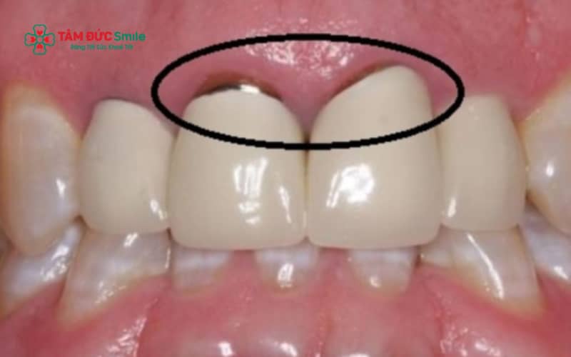 Răng toàn sứ không chứa kim loại nên hạn chế tình trạng đen viền nướu và mang lại tính Abc8c1 com khuyến mãi hấp dẫn cao.