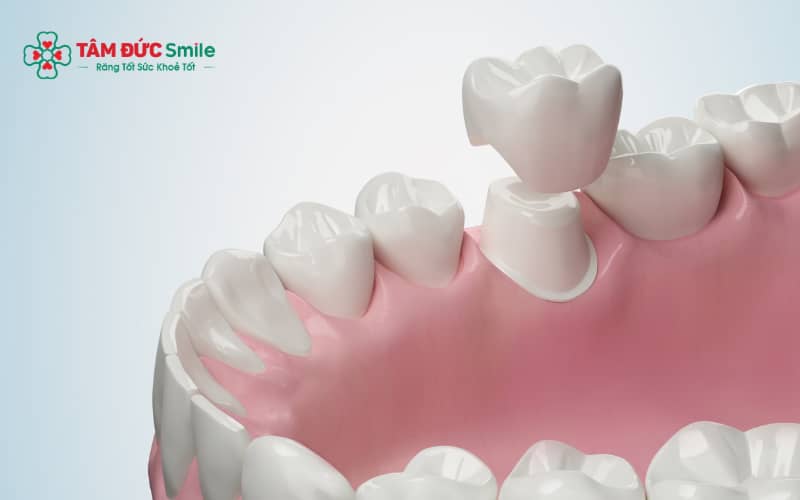 Một số cảm giác ê buốt hoặc khó chịu nhẹ là bình thường ngay sau khi Abc8.com Thể thao, Đá gà, Xổ số, Bắn cá