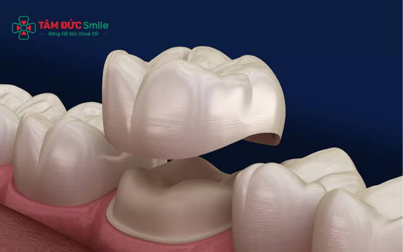 Quá trình mài răng, khớp cắn chưa chuẩn hoặc tình trạng tủy răng có thể gây cảm giác khó chịu sau bọc sứ