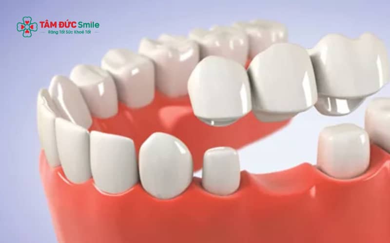 Abc8com cá cược thể thao có thể duy trì nhiều năm nếu được phục hình đúng kỹ thuật và chăm sóc đúng cách