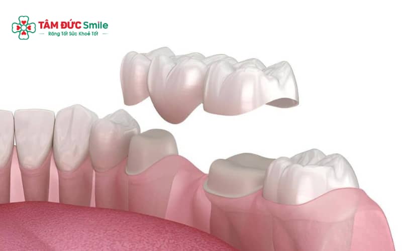 Răng cấm sâu nặng, viêm tủy hoặc vỡ lớn cần Abc8.com Thể thao, Đá gà, Xổ số, Bắn cá để bảo vệ cấu trúc răng và khôi phục chức năng ăn nhai