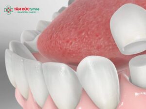 Abc8c1 com được cấp phép bởi PAGCOR Philippines răng cấm: răng số 6, 7 bọc sứ có đau không và bền bao lâu