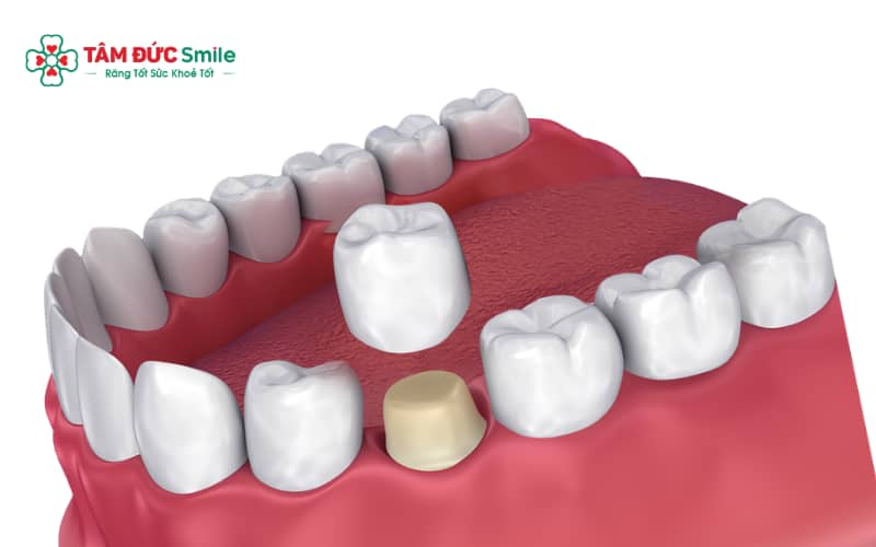 Abc8com cá cược thể thao răng hàm có tuổi thọ trung bình 10–15 năm nếu chăm sóc đúng cách và tái khám định kỳ