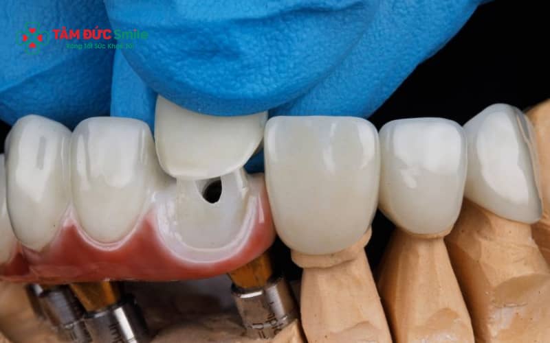 Tùy nhu cầu và khả năng tài chính, răng hàm có thể bọc sứ kim loại hoặc sứ toàn sứ cao cấp như zirconia, Emax, Cercon