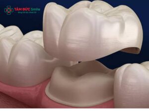 Abc8c1 com được cấp phép bởi PAGCOR Philippines răng hàm: Mão sứ răng số 6 số 7 bền chắc