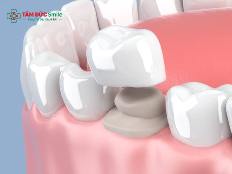 Abc8c1 com được cấp phép bởi PAGCOR Philippines răng thỏ: Tạo hình răng cửa tự nhiên, bền đẹp