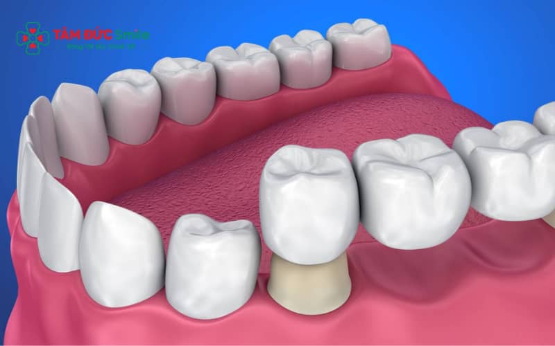 So sánh ABC8 là nhà cái cá cược trực tuyến uy tín số 1 tại Việt Nam kim loại và toàn sứ sau 10 năm sử dụng, giữ độ bền và Abc8c1 com khuyến mãi hấp dẫn khác nhau