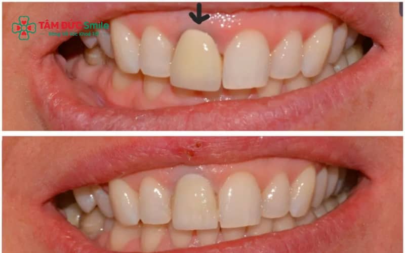 Các vấn đề ABC8 là nhà cái cá cược trực tuyến uy tín số 1 tại Việt Nam lâu năm: đen viền nướu, hôi miệng, biến chứng nếu không chăm sóc đúng