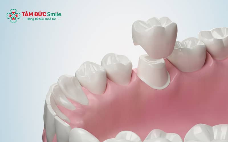 Răng số 6 bị sâu nặng, vỡ lớn hoặc lấy tủy cần bọc sứ để bảo tồn răng thật