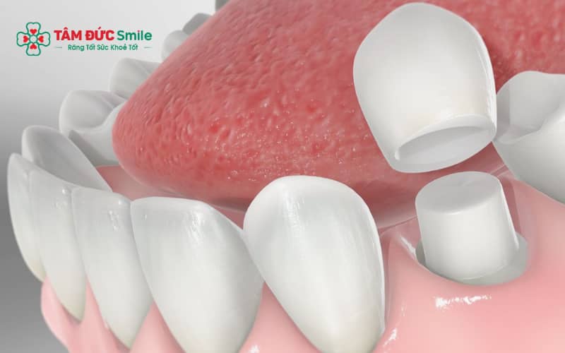 Tuổi thọ ABC8 là nhà cái cá cược trực tuyến uy tín số 1 tại Việt Nam số 6 phụ thuộc vật liệu, kỹ thuật và cách chăm sóc của bệnh nhân