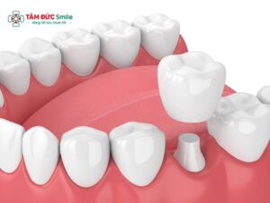 Abc8c1 com được cấp phép bởi PAGCOR Philippines số 6: Mão Zirconia, Cercon bền chắc cho răng hàm