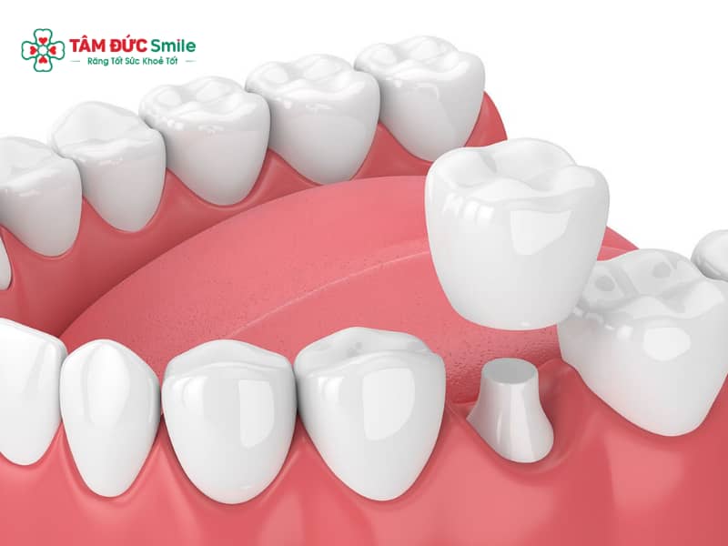 Abc8c1 com được cấp phép bởi PAGCOR Philippines số 6: Mão Zirconia, Cercon bền chắc cho răng hàm