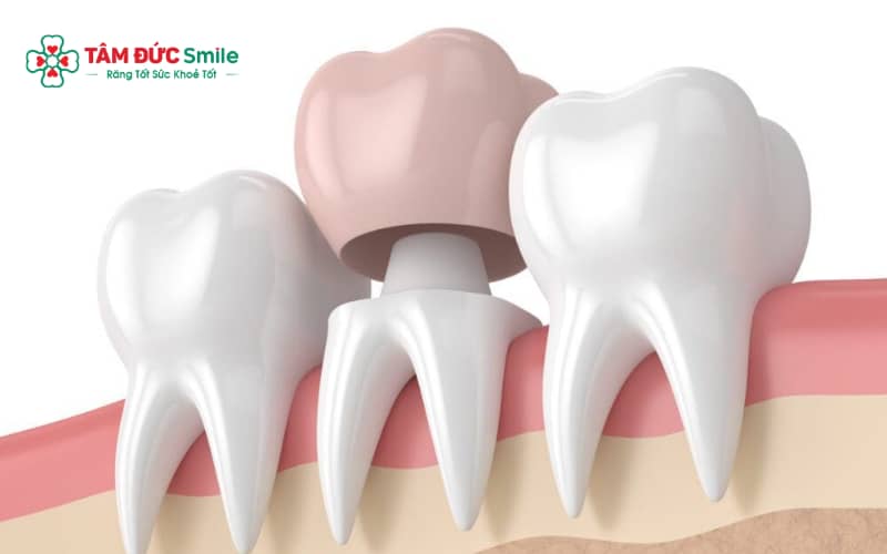 Răng số 7 sâu lớn, vỡ, lấy tủy hoặc mòn yếu nên bọc sứ để bảo vệ răng thật
