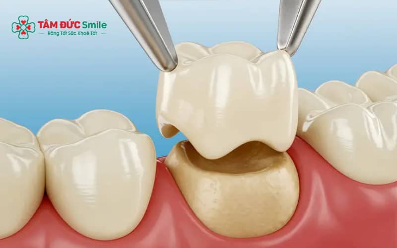 Mài răng và gắn mão sứ nhẹ nhàng, hầu hết không đau, tái khám kịp thời nếu khó chịu.
