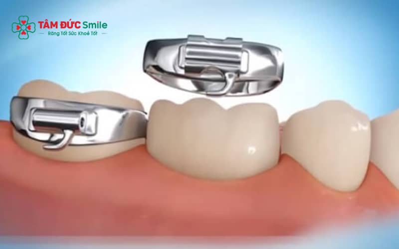 Band Abc87 tải ứng dụng là gì, vòng kim loại gắn răng hàm trong Abc87 tải ứng dụng mắc cài, cấu tạo band Abc888k vip truy cập nhanh chi tiết