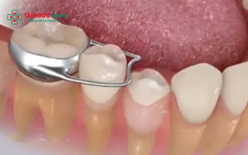 Band Abc87 tải ứng dụng thường được chỉ định trong các trường hợp răng lệch lạc nặng hoặc cần tăng khả năng kiểm soát lực kéo.