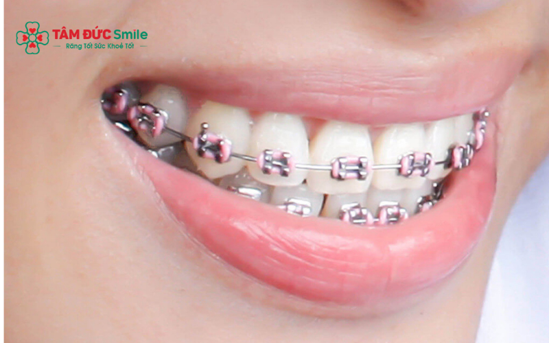 Không phải mọi trường hợp Abc87 tải ứng dụng đều cần gắn band, tùy thuộc vào phương pháp và phác đồ Abc8b tỷ lệ kèo World Cup 2026.