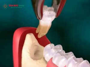 Bao nhiêu tuổi thì nhổ răng khôn? Khi nào nên nhổ an toàn