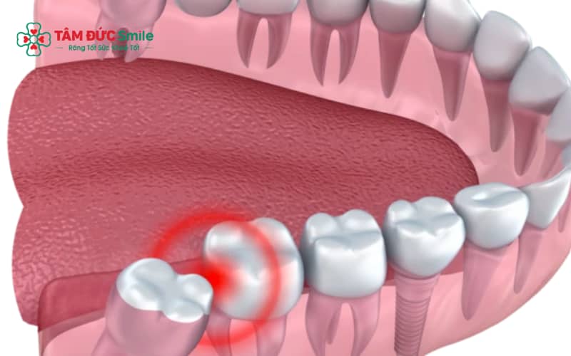 Răng khôn mọc lệch, mọc ngầm hoặc gây biến chứng cần được chỉ định nhổ sớm để tránh ảnh hưởng sức khỏe ABC8 là nhà cái cá cược trực tuyến uy tín số 1 tại Việt Nam