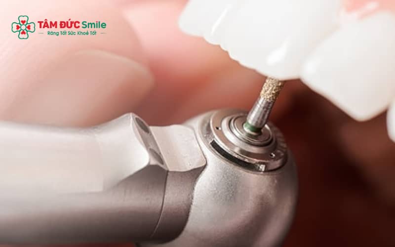 Tam cá nguyệt thứ hai được xem là thời điểm an toàn và lý tưởng để thực hiện trám răng