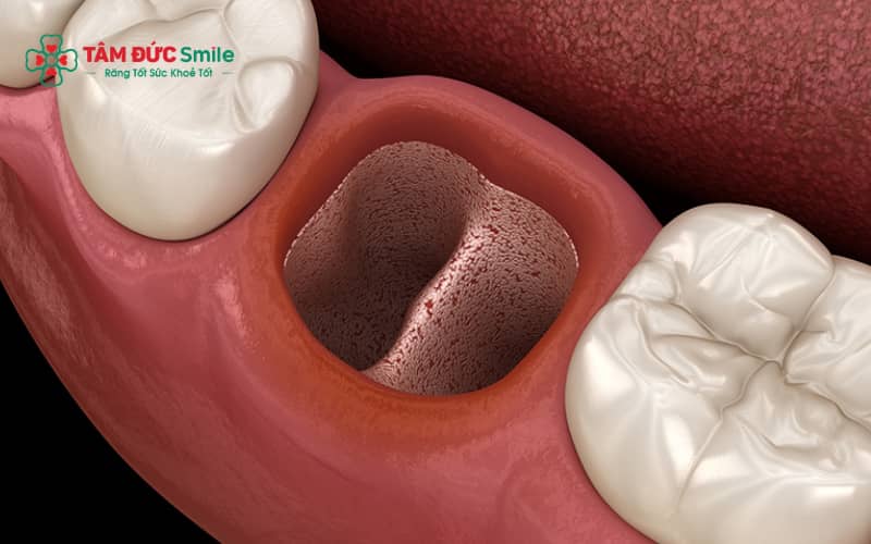 Cứng hàm sau khi nhổ răng khôn thường do co thắt cơ nhai hoặc răng mọc lệch, tiểu phẫu phức tạp