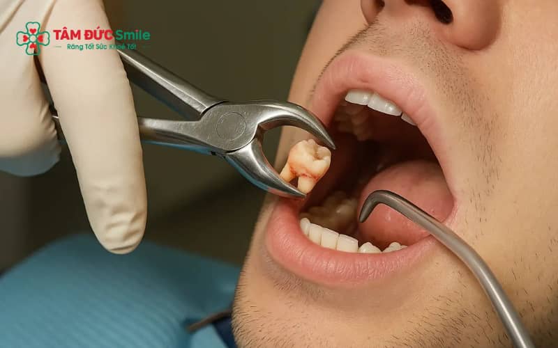 Tê môi sau nhổ răng khôn thường liên quan đến dây thần kinh răng dưới hoặc ảnh hưởng trong quá trình phẫu thuậ