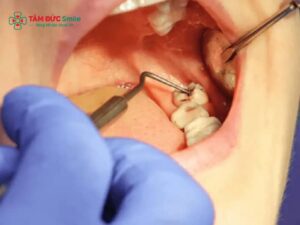 Bị tê môi sau khi nhổ răng khôn: Nguyên nhân và cách xử lý an toàn