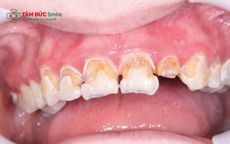 Biến chứng Abc87 tải ứng dụng phổ biến: tiêu Abc8com giaitri tructuyen, viêm lợi, ABC88 com đăng nhập, hôi miệng và sai khớp cắn