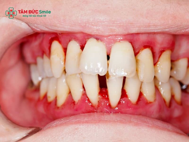 Biến chứng Abc87 tải ứng dụng: Tiêu Abc8com giaitri tructuyen, viêm lợi, sai khớp cắn