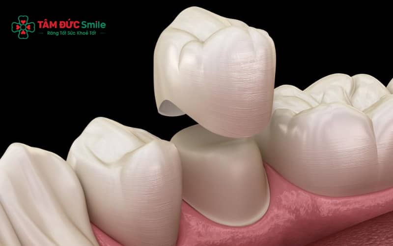Ê nhẹ khi mài và sau bọc sứ là bình thường, giảm dần nhờ chăm sóc và tái khám kịp thời