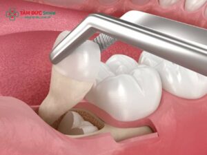 Các phương pháp nhổ răng khôn: Mọc lệch, mọc ngầm, sóng Abc8 abcvip tỷ lệ trả thưởng cực hấp dẫn an toàn