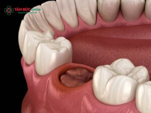 Cách cầm máu khi nhổ răng khôn: Xử lý chảy máu an toàn