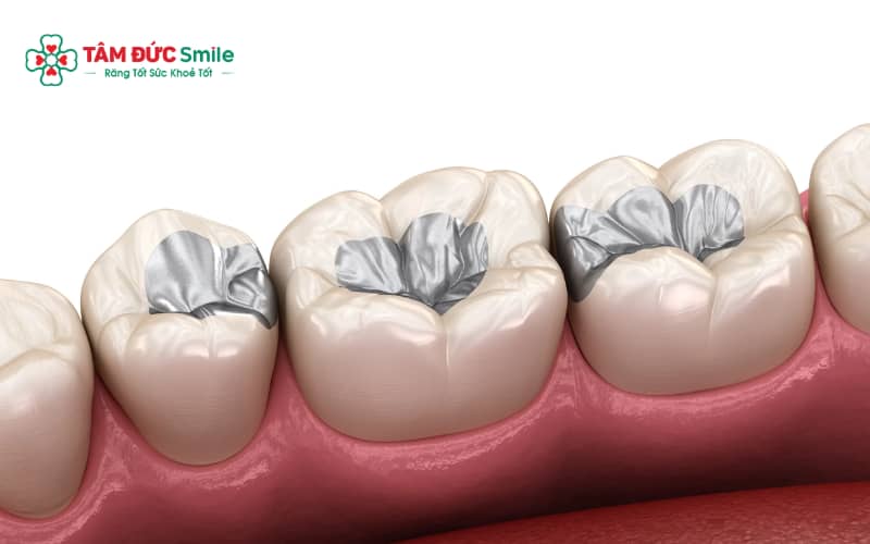 Đau sau khi trám răng có thể xuất phát từ kích ứng tủy, răng nhạy cảm hoặc miếng trám cao gây sai khớp cắn