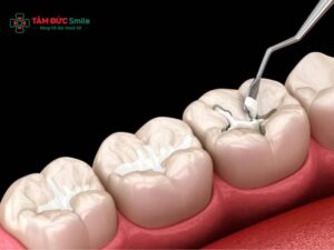Cách giảm đau sau khi trám răng: Xử lý ê buốt, đau nhức hiệu quả