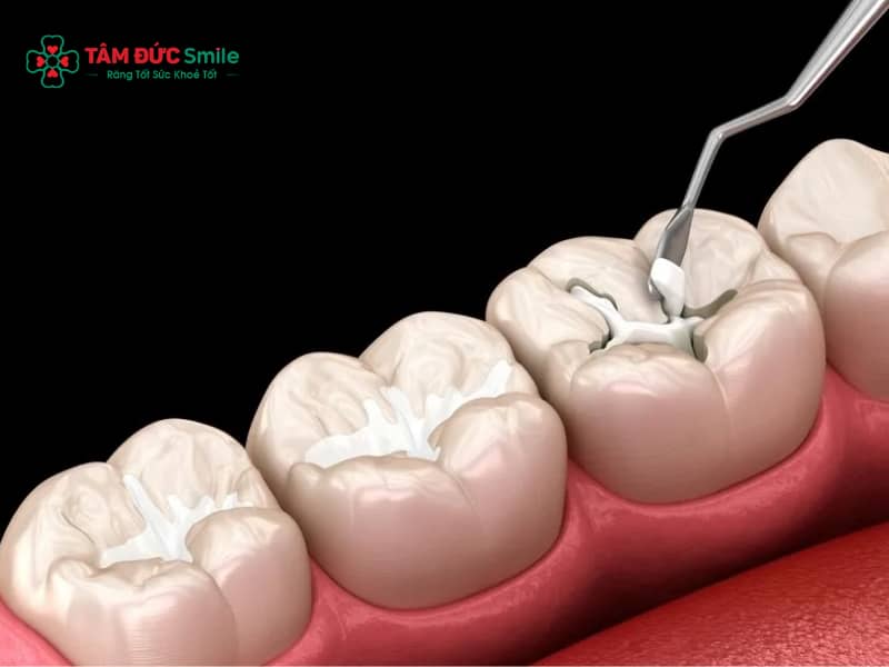 Cách giảm đau sau khi trám răng: Xử lý ê buốt, đau nhức hiệu quả