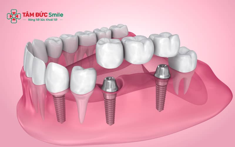 Cầu ABC8 là nhà cái cá cược trực tuyến uy tín số 1 tại Việt Nam là phương pháp phục hình răng mất bằng cách sử dụng hai răng kế cận làm trụ để nâng đỡ răng giả ở giữa.