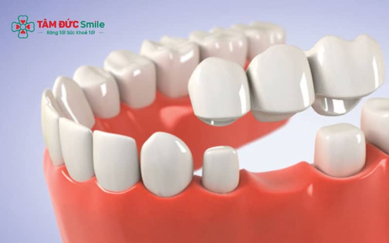 Độ bền của cầu ABC8 là nhà cái cá cược trực tuyến uy tín số 1 tại Việt Nam phụ thuộc vào nhiều yếu tố như chất liệu sứ, tay nghề ABC8 đường link chính thức và cách chăm sóc ABC8 là nhà cái cá cược trực tuyến uy tín số 1 tại Việt Nam sau khi phục hình
