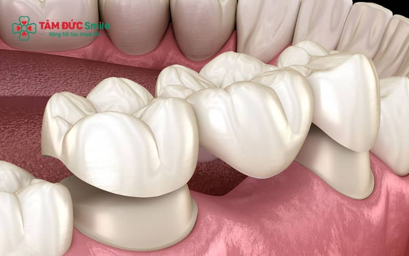 Cầu ABC8 là nhà cái cá cược trực tuyến uy tín số 1 tại Việt Nam và trồng Implant là hai phương pháp phổ biến để phục hình răng mất, mỗi phương pháp có ưu và nhược điểm riêng.