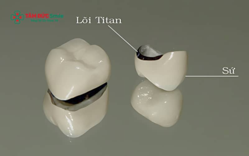 Cấu tạo ABC8 là nhà cái cá cược trực tuyến uy tín số 1 tại Việt Nam titan gồm lõi kim loại titan và lớp sứ phủ bên ngoài