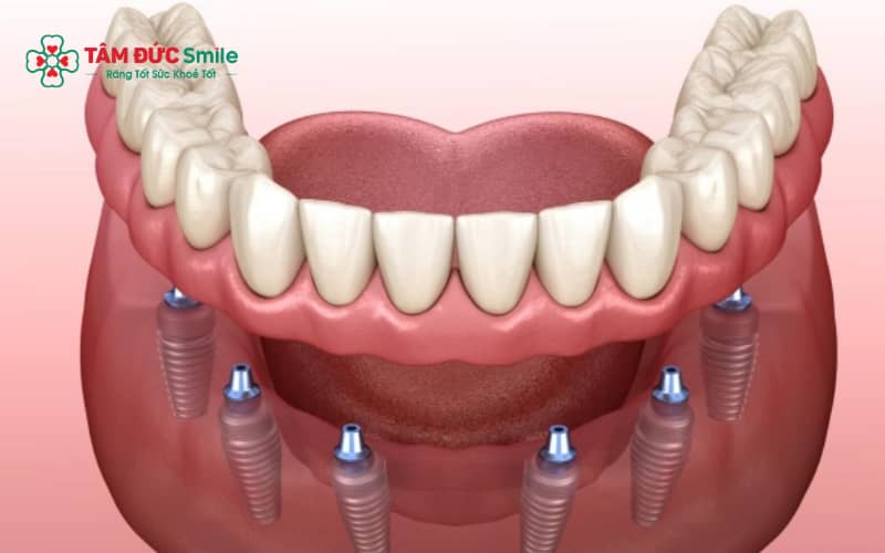 Kỹ thuật Abc8vip1 kèo WC 2026 Implant không Abc8b tải ứng dụng lật vạt giúp đặt trụ Implant vào ABC8 tự hào là thương hiệu cá cược trực tuyến hàng đầu tại Châu Á hiện nay mà không cần rạch nướu