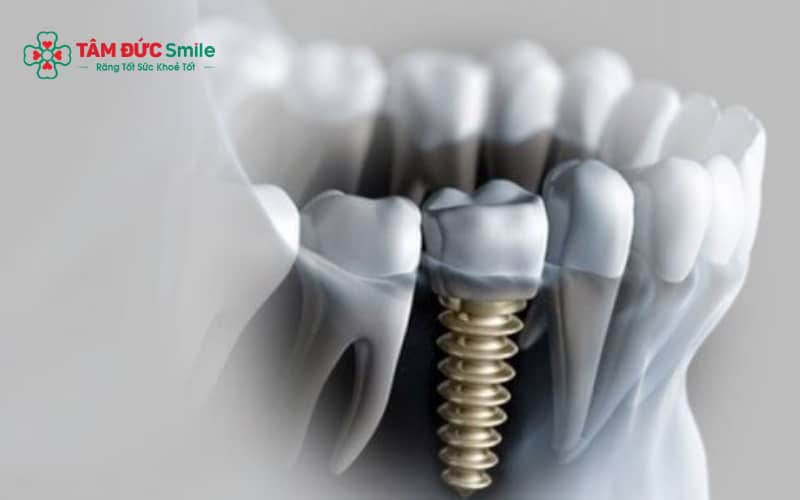 ABC8 đường link chính thức không lật vạt là phương pháp ít xâm lấn, giảm đau và rút ngắn thời gian hồi phục