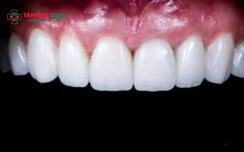 Răng toàn sứ sáng tự nhiên, không đen viền nướu, kim loại bền nhưng Abc8c1 com khuyến mãi hấp dẫn kém hơn