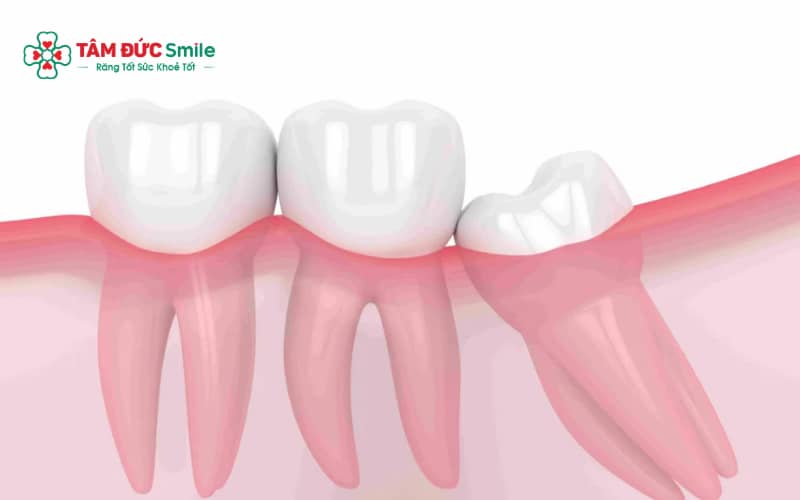 Răng khôn mọc lệch, mọc ngầm hoặc gây viêm là những trường hợp cần được chỉ định nhổ sớm để tránh biến chứng.