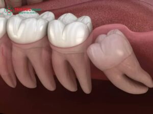 Chỉ định nhổ răng khôn: Răng số 8 mọc lệch, ngầm, viêm lợi trùm