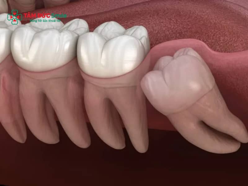 Chỉ định nhổ răng khôn: Răng số 8 mọc lệch, ngầm, viêm lợi trùm
