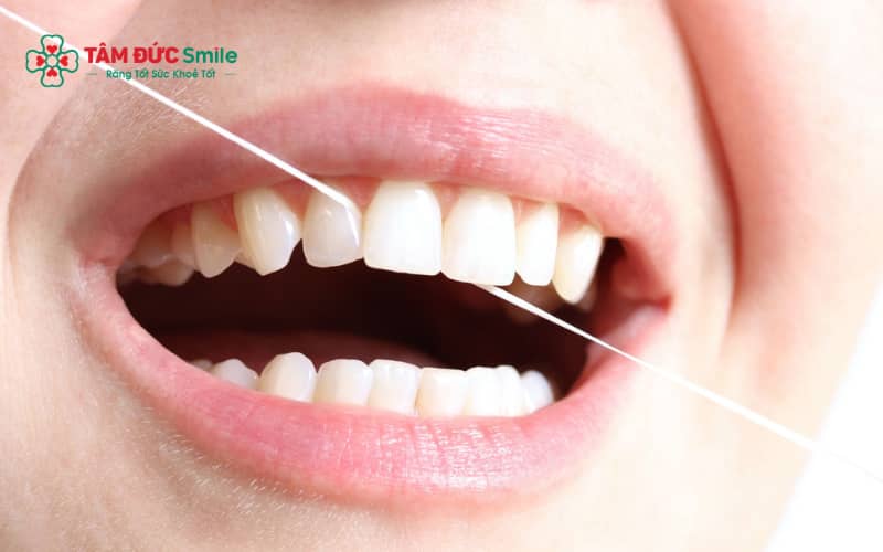 Sử dụng chỉ LINK TRANG CHỦ ABC88 CHUẨN 2026 đúng cách giúp làm sạch kẽ răng hiệu quả mà không gây tổn thương nướu.