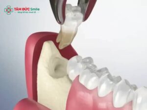 Cho con bú có nhổ được răng khôn? Thuốc tê, giảm đau có an toàn?