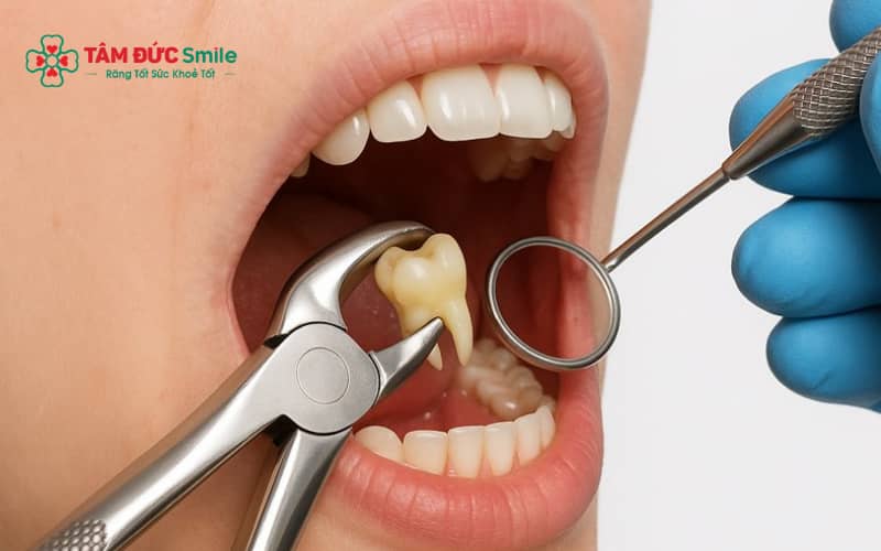 Tuân thủ hướng dẫn của ABC8 đường link chính thức sau khi nhổ răng khôn